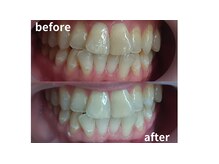 ココホワイトニング(coco whitening)/【30代女性/初ホワイトニング】