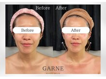 ガーネ 堺店(GARNE)/小顔・リフトアップ１回/30代