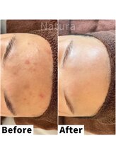 ナトゥーラ 心斎橋なんば本店(Natura)/ニキビ.肌荒れケア/心斎橋なんば