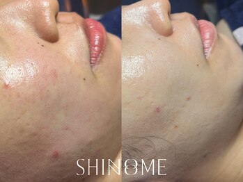 シノノメ(SHINONOME)/*ニキビケア・お肌のトーン