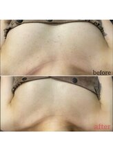 エミルカ 鹿児島店(EMILUCA)/ハーブピーリング