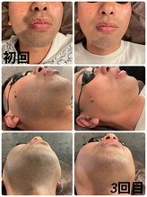 サクロス(Sacloth)/30代後半確実に効果実感したい方