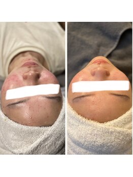 ラヴィ(La vie)/ハーブピーリング/ニキビケア