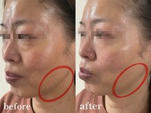 エピリス(Epiliss)/フェイスラインビフォーアフター