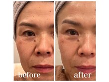 ルー ハナレ 神戸岡本 摂津本山店(Luu HANARE)/小顔シミ・しわ・たるみ改善