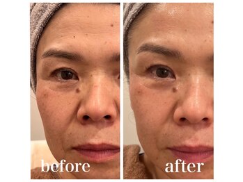 ルー ハナレ 神戸岡本 摂津本山店(Luu HANARE)/小顔シミ・しわ・たるみ改善