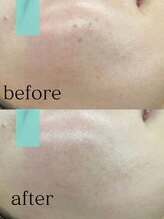 ジェリー(JERRY)/シミケア