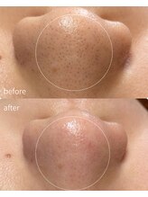 リリーラボ(LILY LAB)/毛穴洗浄症例