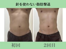 ソルニス(Solnis.)/痩身☆脂肪分解/ハイパーナイフ