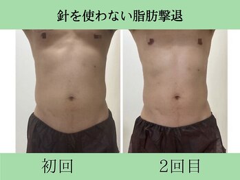 ソルニス(Solnis.)/痩身☆脂肪分解/ハイパーナイフ