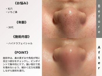 ルディラ医療提携エステ 立川店 毛穴/小顔/ニキビ・シミ・美白・シワ・たるみケア/ハイドラフェイシャル