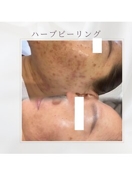 ミツレイ 九条店(MITUREI)/ハーブピーリング☆ニキビケア