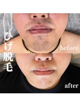 モンレーヴ(MonReve)/ひげ脱毛