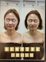 ジェルベーラ(GERBERA)/やはり一番人気の小顔矯正術♪
