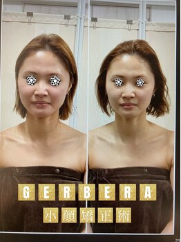 ジェルベーラ(GERBERA)/やはり一番人気の小顔矯正術♪