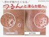 【専門機関導入実績◎】固くなった毛穴の角栓 全顔取り放題！　¥10000→¥8500