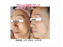 セレブリティ(Celebrity)の雰囲気（1度で効果絶大！お肌のくすみ・赤み・ニキビケアならララピール）