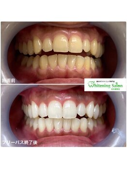 ホワイトニングサロン 名古屋駅店/【ホワイトニング施術例】
