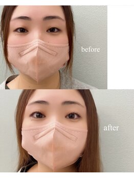 アン(anne)/before・after