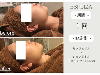 エスプライザ 横浜駅前店/大人気レモンボトル【小顔】