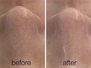 リスポアラボ(LIS PORE.LAB)/1回BeforeAfter