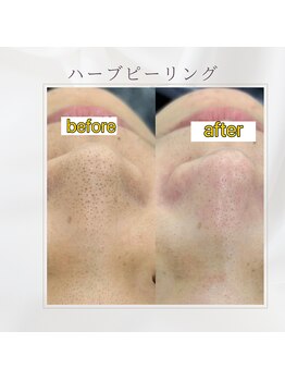 ミツレイ 九条店(MITUREI)/ハーブピーリング/黒ずみ毛穴