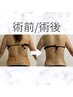 人気No. 1【術前・術後】ダウンタイムインディバ120分　￥22,000→¥14,000