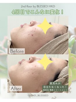 セカンドフロア バイ ブレスト ハコダテ(2nd floor by BLESSED HKD)/ざらつきやぶつぶつの改善にも◎