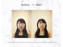ユーニマルヨン(ewe204)/小顔調整のビフォーアフター