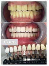 ココホワイトニング 天王寺店/ビフォーアフター３