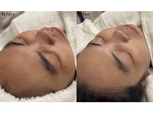 ハルム(HaluM)/直後からゴワつき・くすみ改善◎