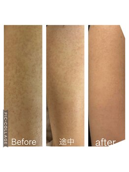 オアジスパ(Oasi Spa)/黒いプツプツサメ肌毛穴5回