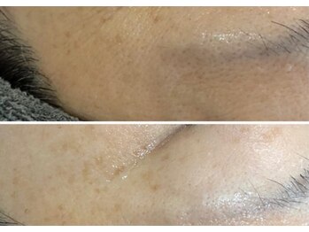 ルアーナ(Luana)/ハーブピーリング