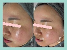 ミウル 天王寺店(miulu)/30代/ハーブピーリング１回