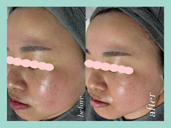 ミウル 天王寺店(miulu)/30代/ハーブピーリング１回