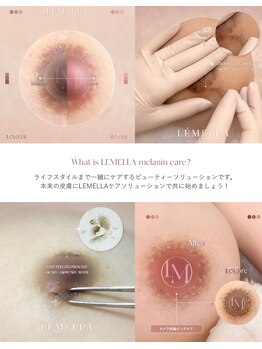 サロンヴィヴィ 大阪心斎橋店(salon ViVi)の写真/【心斎橋駅】唇・VIOの黒ずみ改善！韓国発ルメラで痛みも少なく美白/ニキビケア/シミケア/リタッチ保証付