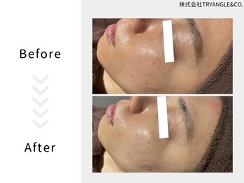 美活ラボ(美活LABO)/ハーブピーリング