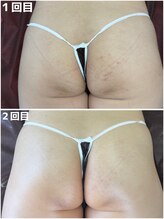 カシェボーテ(CACHE BEAUTE)/ボディのニキビにプラズマ