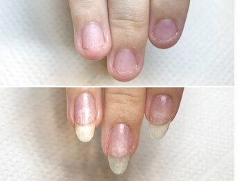 グラシュータン(gracieux temps)/深爪矯正