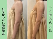 ソルニス(Solnis.)/痩身☆脂肪分解/ハイパーナイフ