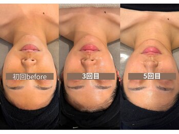 ステラ(STELLA)/【超小顔術】韓国小顔バンテージ