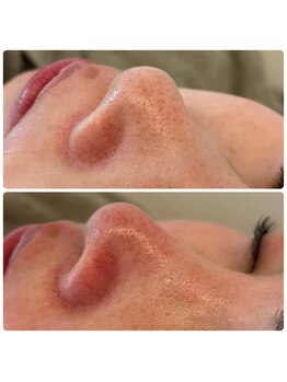 ネオファースト 大阪福島店(NeoFirst)/美容液で洗う吸引ケア#毛穴洗浄