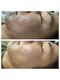 リーフィ 荻窪(Leafy)の写真/【チクッと実感、毛穴ケア】ハーブピーリングで、たるみ・開き・オイリー肌をリセットしツヤ肌へ導きます★