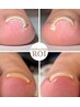 【FOOT】巻き爪ケア+フットワンカラー