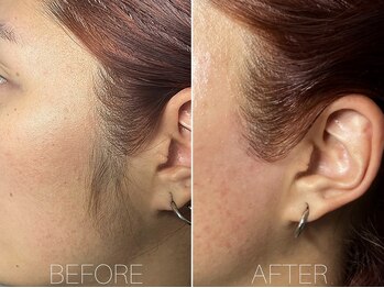 エヴァワックス 銀座店(Eva Wax)/【お手軽】もみあげ脱毛