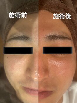 ツール(TOOL)/LED脱毛×プラズマシャワー