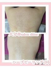 サロンシャイン(Salon Shine)/ハードタイプ　ハーブピーリング