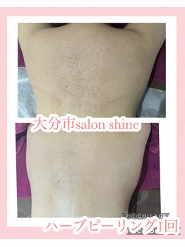 サロンシャイン(Salon Shine)/ハードタイプ ハーブピーリング