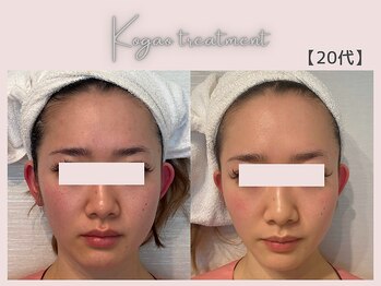 美シェリ(美Cheri)/小顔矯正ビフォーアフター