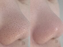 アンドミー 鳥取米子店(&me)/毛穴洗浄【黒ずみ/開き改善】